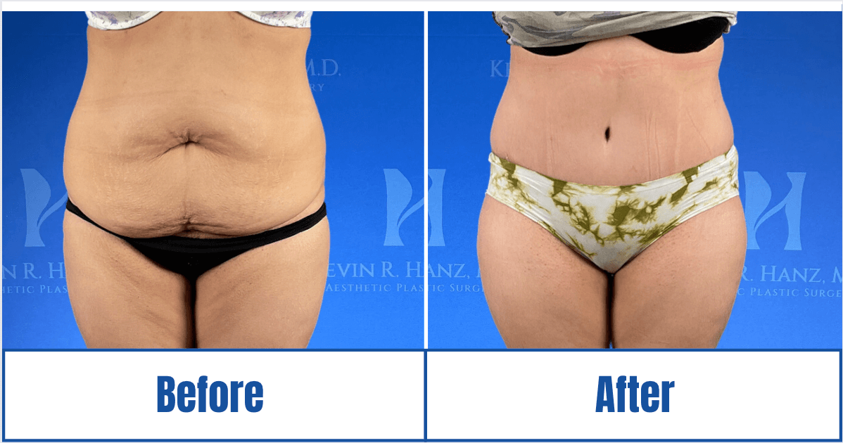 Before and after image of a woman showcasing visible results of abdominoplasty in Dallas, TX