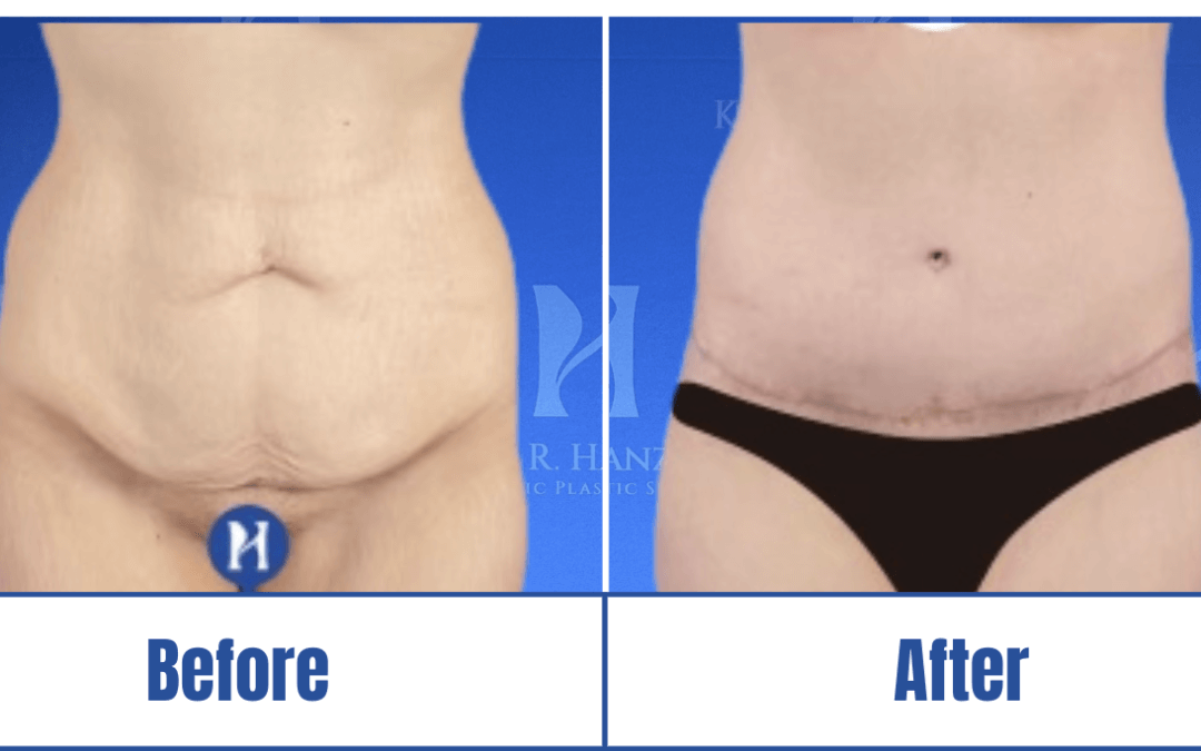 Before and after image of a woman who underwent abdominoplasty in Dallas, TX