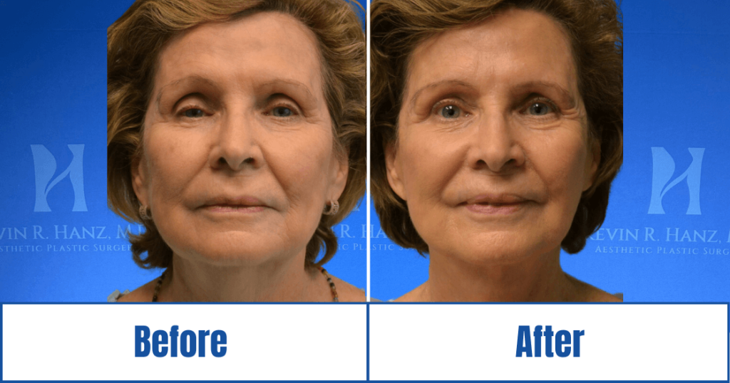 Before and after image of a woman who underwent face and neck lift in Dallas, TX