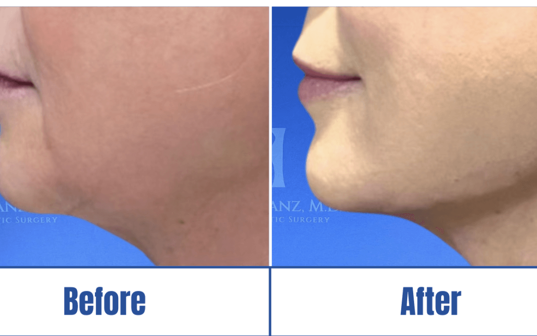 A before and after image of a woman who underwent jawline filler surgery in Dallas, TX.