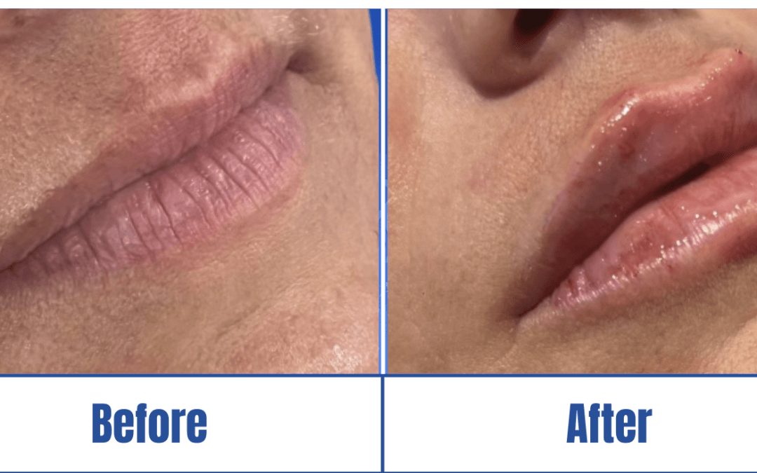 A woman underwent lip filler surgery in Dallas, TX, and showed the before and after images.