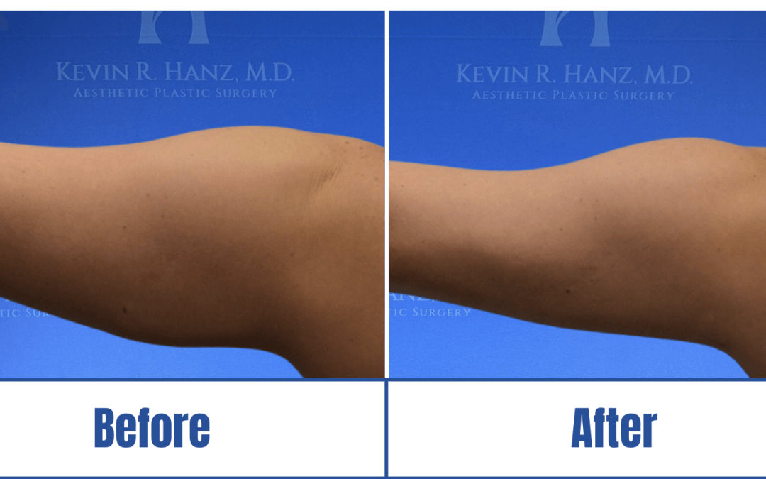 Before and after image of a woman's arms who underwent liposuction in Dallas, TX.