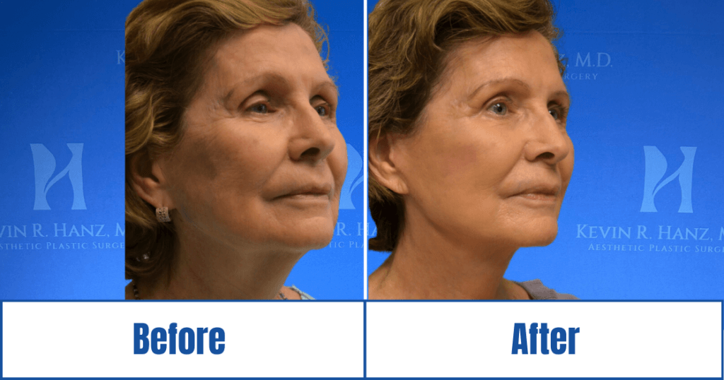 Side image of a woman who underwent face and neck lift in Dallas, TX