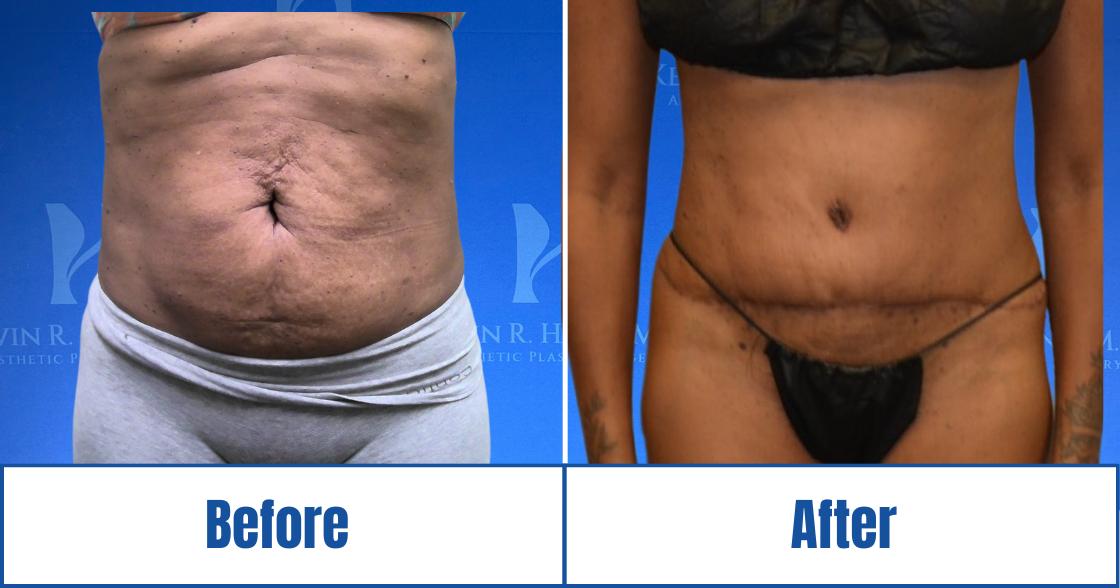 Before and after image of a woman showcasing visible results of abdominoplasty in Dallas, TX