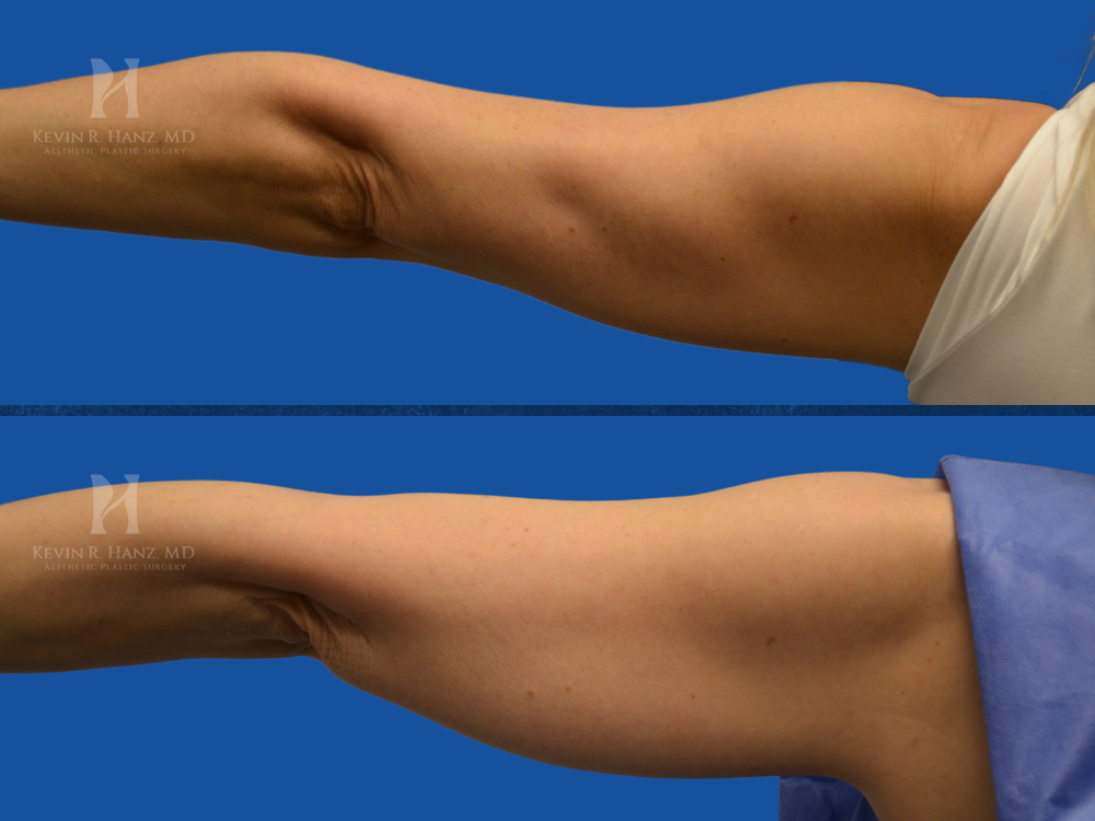 Before and after image of a patient&#039;s arm following liposuction, showing improved contour, reduced fat, and a tighter, more defined upper arm appearance.