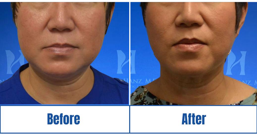 Screen Shot 2023-11-27 at 2.16.31 PM Before and After View of a Man highlighting Facetite Treatments in Dallas, TX