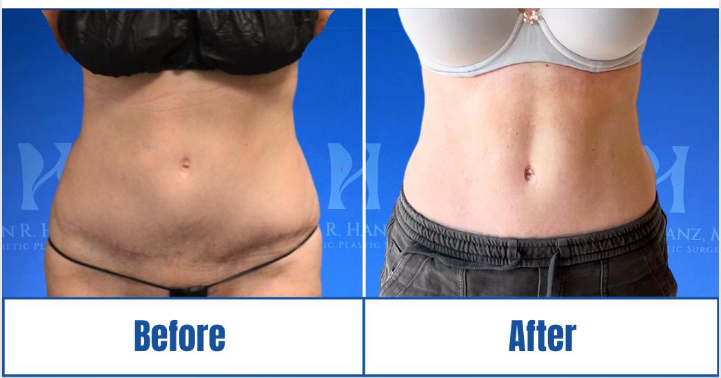 Screen Shot 2023-11-27 at 3.29.02 PM Before and After View of a woman highlighting Liposuction treatment in Dallas, TX