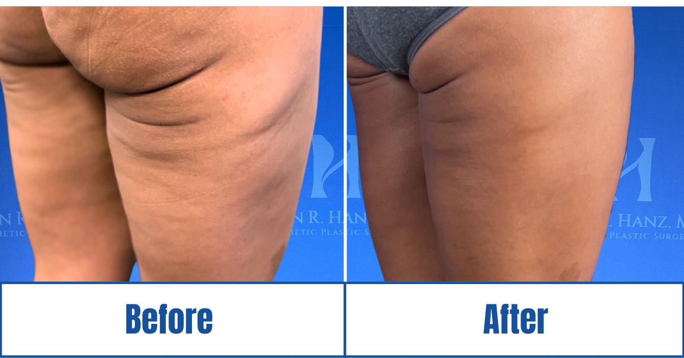 Before and After View of Woman Highlighting Morpheus Treatments in Dallas, TX
