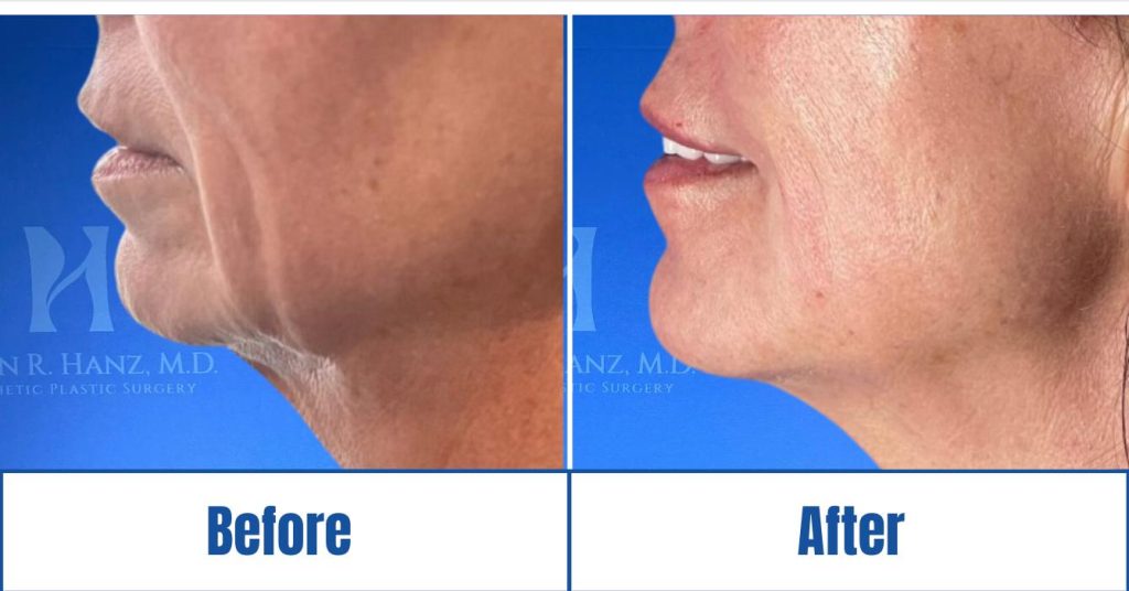 InstaLift Threads before and after result of an old woman in Dallas, TX