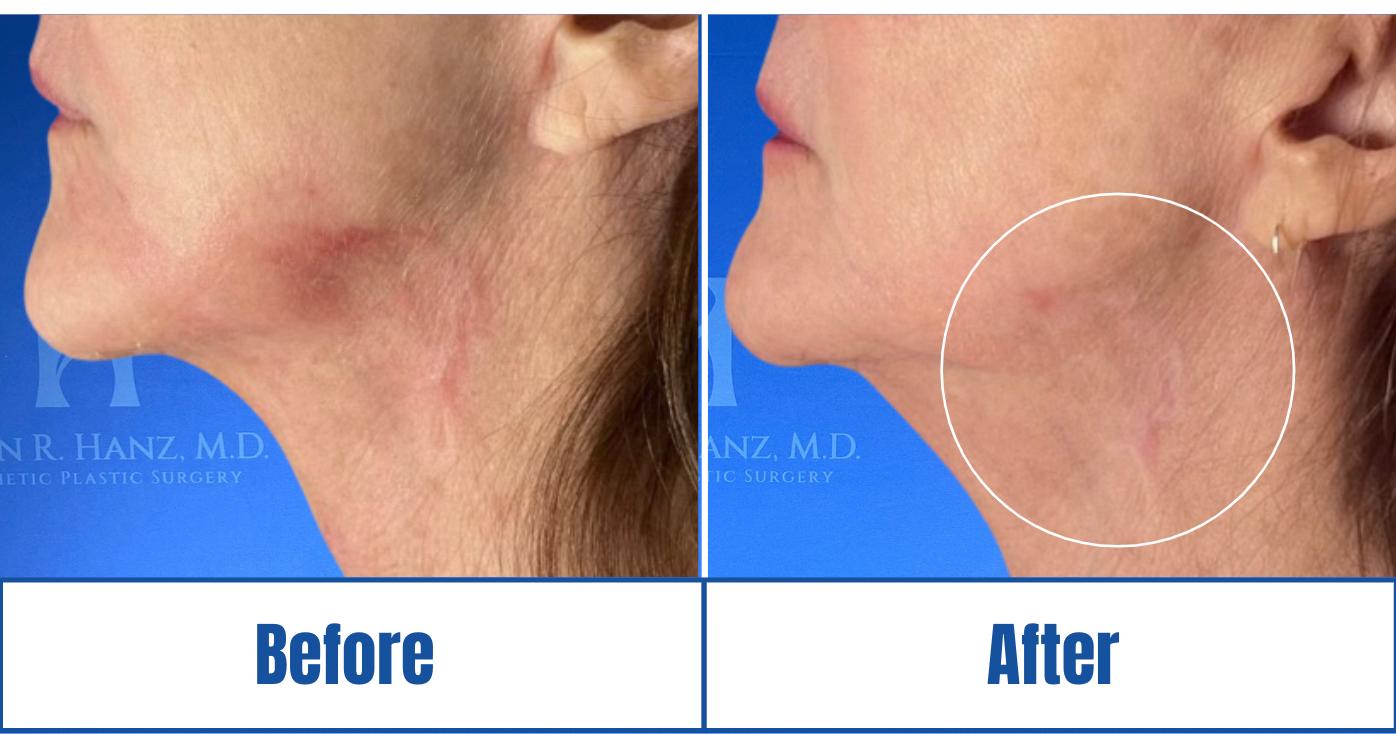 Before and After View of Morpheus Scar Restoration Treatments in Dallas, TX