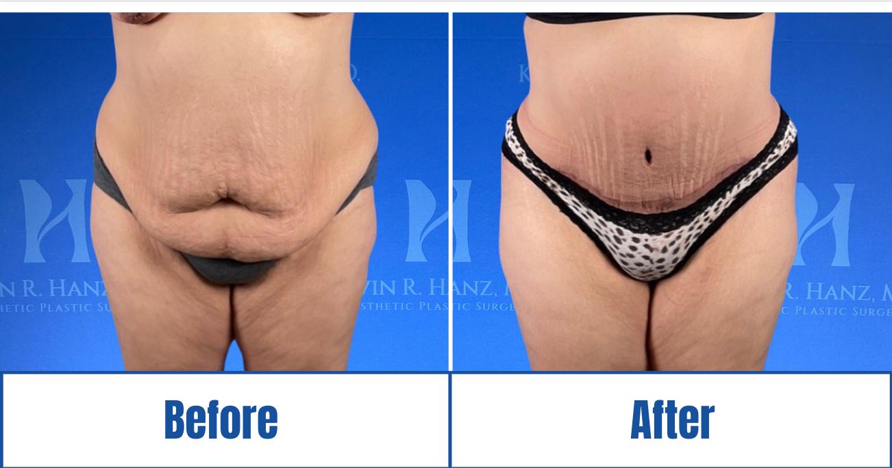 Screen Shot 2024-05-06 at 10.43.49 AM Before and After View of a woman's visible results of abdominoplasty treatment in Dallas, TX