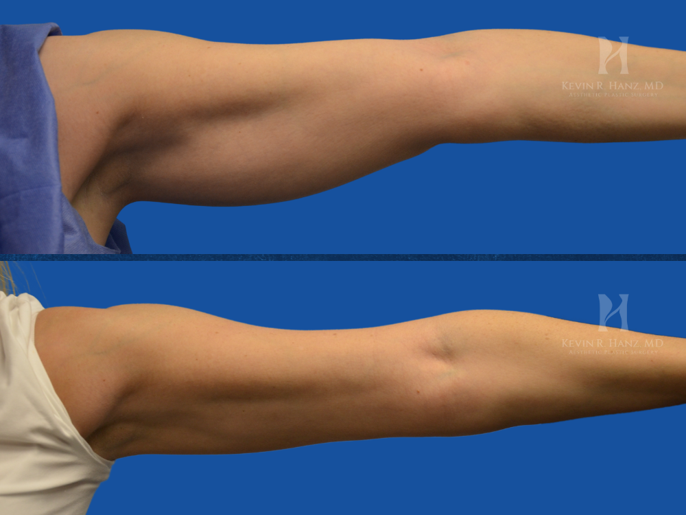 Arm Skin Tightening Before and after results of arm skin tightening using Renuvion, showing reduced sagging and smoother, firmer upper arms.