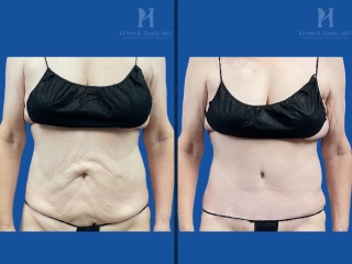 Before and after tummy tuck on a small-framed patient showing tightened abdominal skin, a flatter stomach, and refined midsection contours.