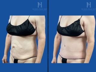 Before and after tummy tuck on a small-framed patient showing tightened abdominal skin, a flatter stomach, and refined midsection contours.
