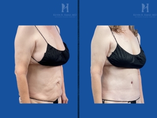 Before and after tummy tuck on a small-framed patient showing tightened abdominal skin, a flatter stomach, and refined midsection contours.