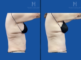 Before and after tummy tuck on a small-framed patient showing tightened abdominal skin, a flatter stomach, and refined midsection contours.