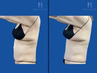 Before and after tummy tuck on a small-framed patient showing tightened abdominal skin, a flatter stomach, and refined midsection contours.