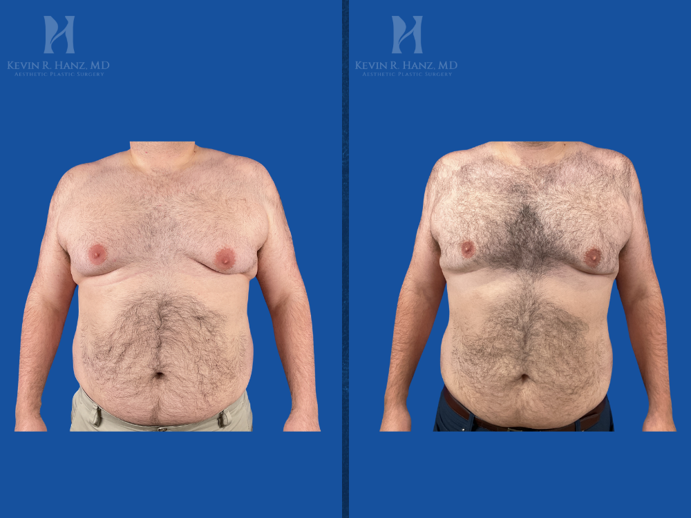 Before and after weight loss results from GLP-1 medication program showing reduced abdominal fat and improved body contour under the care of Dr. Kevin Hanz.