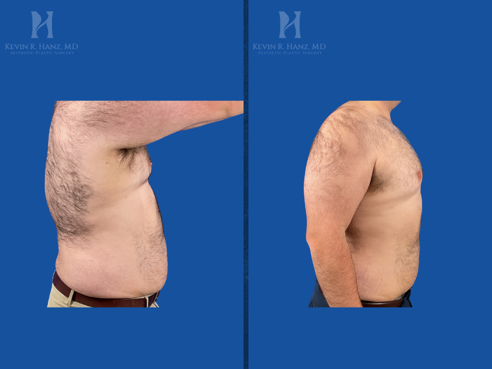 Before and after weight loss results from GLP-1 medication program showing reduced abdominal fat and improved body contour under the care of Dr. Kevin Hanz.