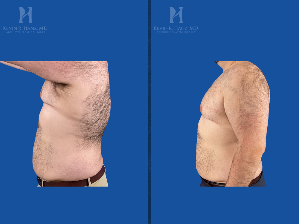 Before and after weight loss results from GLP-1 medication program showing reduced abdominal fat and improved body contour under the care of Dr. Kevin Hanz.