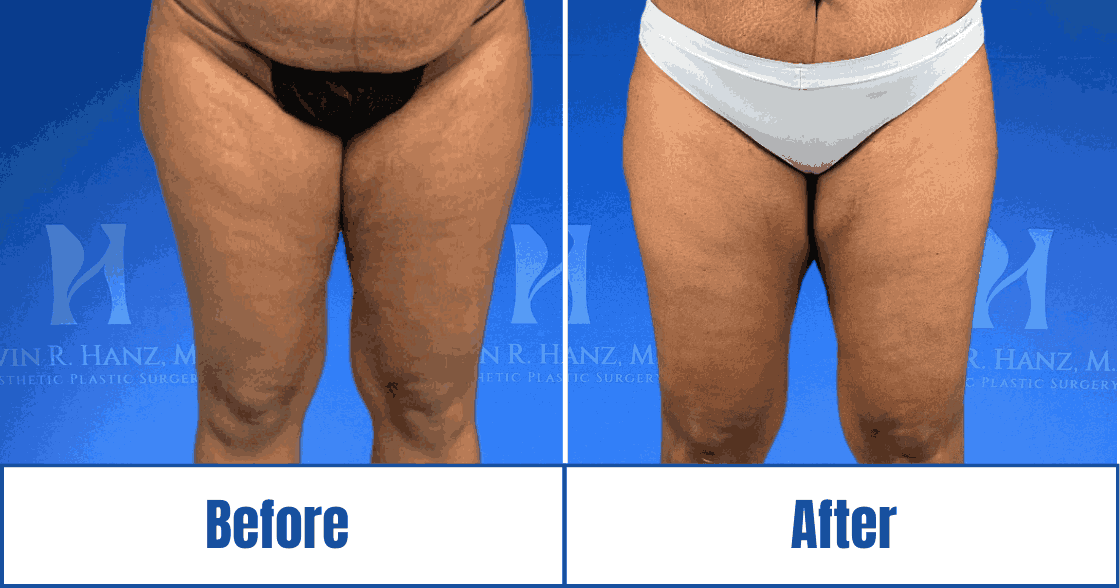 Before and after image of a cosmetic treatment performed in the Dallas-Fort Worth Metropolitan Area<br />
