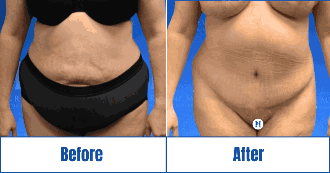 Cosmetic transformation imagery featuring a patient in the Dallas-Fort Worth Metropolitan Area<br />
