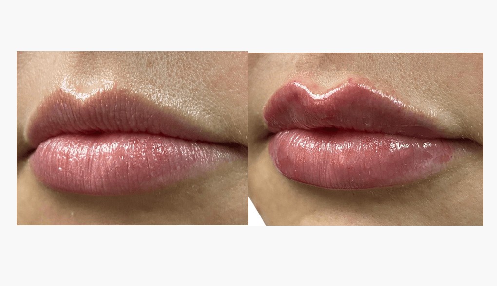 Fillers in Dallas-Fort Worth: enhanced lip volume and shape shown in this before-and-after image<br />
