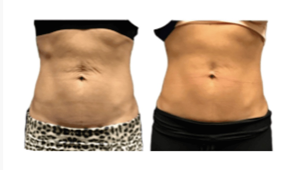 EvolveTite® by InMode in Dallas-Fort Worth: tighter, smoother abs in this body contour result<br />
