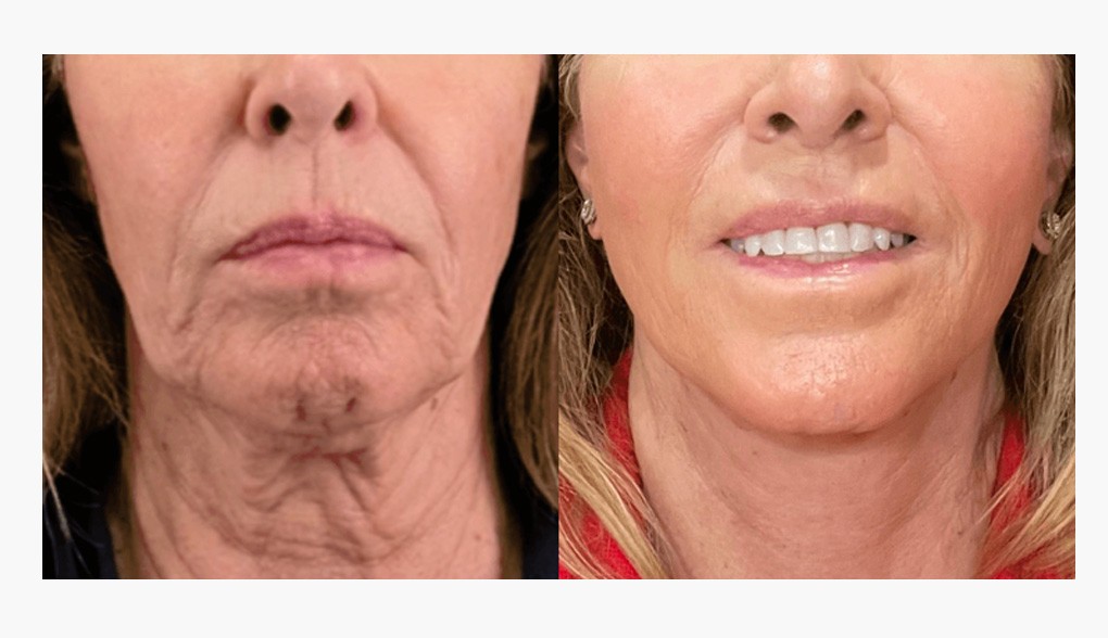 Facelift in Dallas-Fort Worth: dramatic rejuvenation with tighter skin and youthful contours<br />
