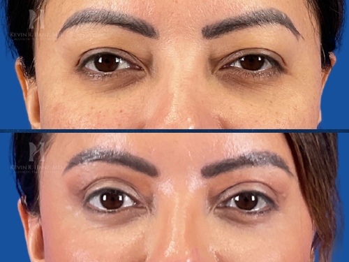 Eye lift before and after results of a woman after surgery in the Dallas-Fort Worth area
