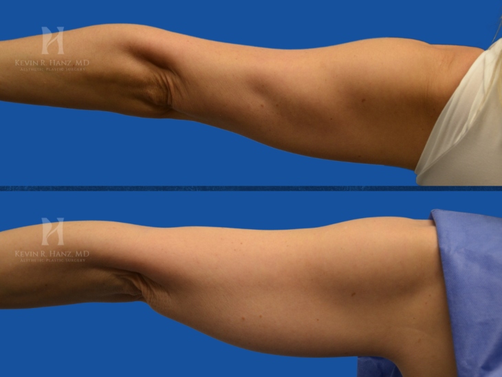 Skin tightening before and after results of a woman after surgery in the Dallas-Fort Worth area