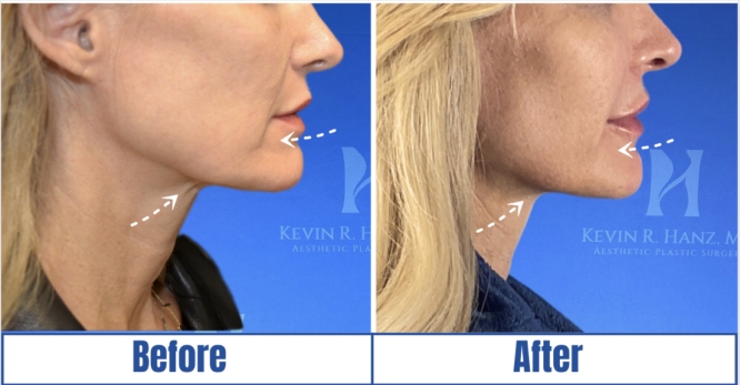 Face-lift before and after result of a woman in Dallas, TX