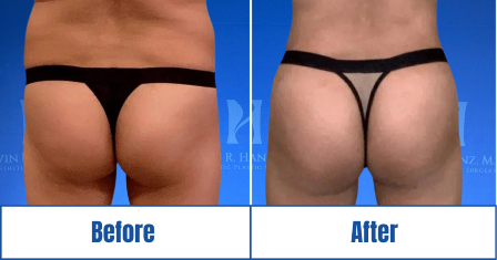 Brazilian Butt Lift Surgery Before and After results of a woman in Dallas, TX