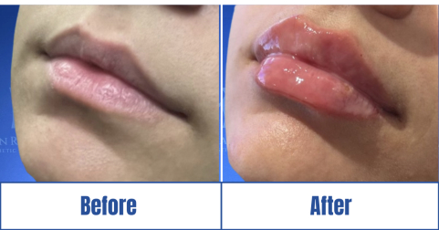 Lip Filler