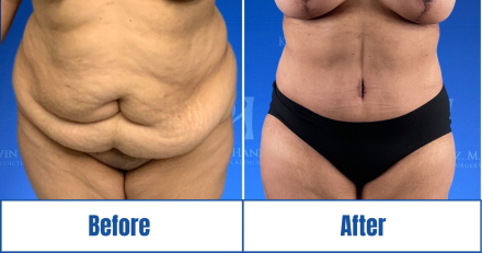 Liposuction Before and After results of a woman in Dallas, TX