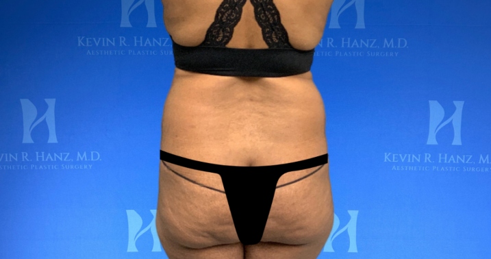 back-side-view-liposuction-before Back side view of a woman before Liposuction in Dallas, TX