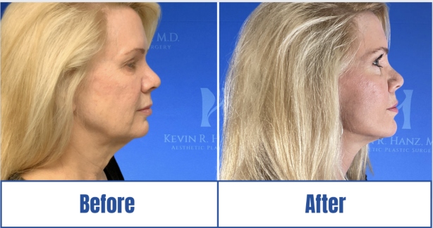 face-lift-surgery-before-after Face Lift Surgery side view before and after results of a woman in Dallas, TX