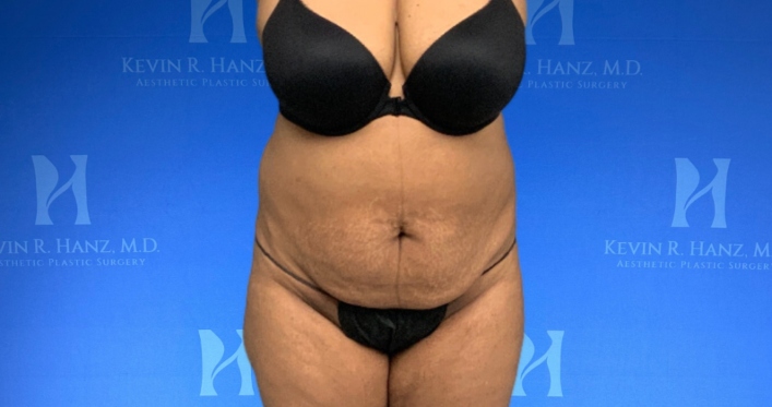 front-view-liposuction-after-result Front view of a woman after liposuction in Dallas, TX