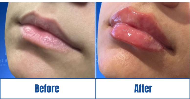 lip-filler-before-after Lip Filler before and after results of a woman in Dallas, TX