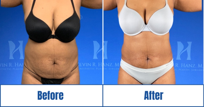 liposuction-before-after-result Liposuction before and after results of a woman in Dallas, TX