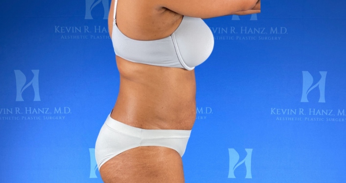 side-view-liposuction-result Side view of a woman after liposuction in Dallas, TX