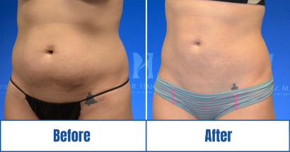 Abdominoplasty Before and After results of a woman in Dallas, TX