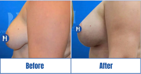 breast-lift-before-after Breast Lift Before and After results of a woman in Dallas, TX