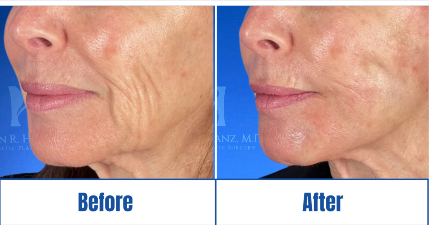 InstaLift Threads Before and After results of a woman in Dallas, TX