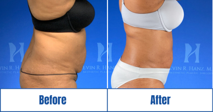 Side view of Liposuction Before and After results of a woman in Dallas, TX