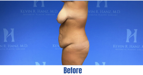 Mommy makeover before surgery image in Dallas, TX