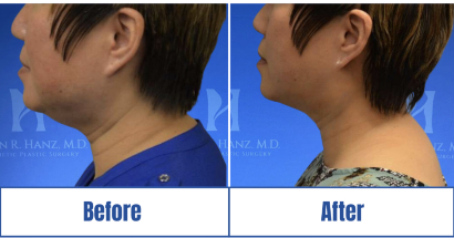 Skintightening side view of Before and After results of a woman in Dallas, TX