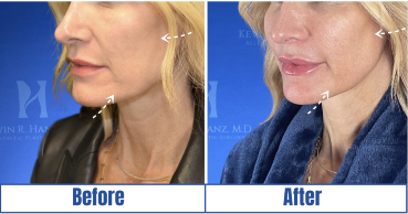trilift-before-after TriLift Before and After results of a pretty woman in Dallas, TX