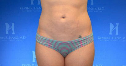 Abdominoplasty after surgery result of a woman in Dallas, TX