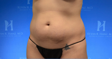 Before abdominoplasty surgery of a woman in Dallas, TX